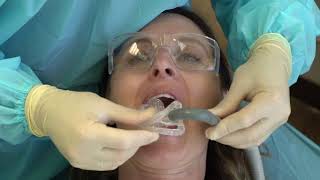 Isolite Anterior Mouthpiece Placement [upl. by Gurevich655]