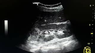 pyelonephritis sonographic signs [upl. by Erihppas]