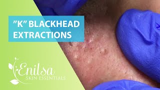 Blackhead Extractions on “K” 10 [upl. by Atiek]