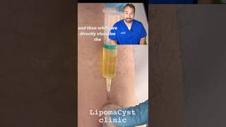 Bakers Cyst drainage under ultrasound [upl. by Darlleen]