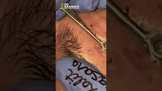 BLACKHEADS REMOVAL OF 50 YEARS OLD BLACKHEADS by DRLALIT KASANA [upl. by Nickelsen]