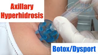 BotoxDysport for Axillary Hyperhidrosis  Dr Weiners Unique Method [upl. by Ainesell]