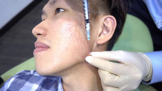 Acne Scar Keloid Steroid Injection  Dr Ho Rui Ming Singapore [upl. by Jones]