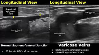 Saphenous Vein Doppler Ultrasound Normal Vs Abnormal  Varicose Veins  Lower Limb Vascular USG [upl. by Naul535]