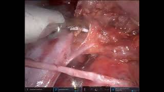 Difficult case03 XiParaaortic LN dissection 16a2int 16b1int [upl. by Jennilee]