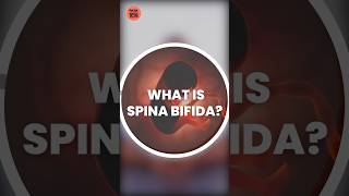 Spina Bifida ये नवजात शिशु में होने वाली बीमारी क्या है spinabifida spinabifidaawareness 1mg [upl. by Dibb]