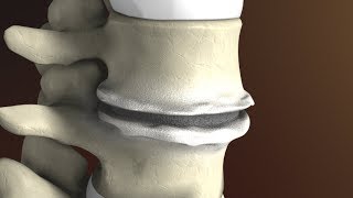 Degenerative Disc Disease Spondylosis explained by Spine Surgeon Dr Jessica Shellock Plano TX [upl. by Naesed]