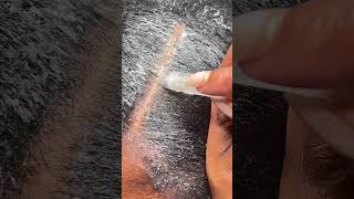 Severe Dandruff Psoriasis or Seborrheic Dermatitis Treatment RejuvaScalp system [upl. by Aynas]