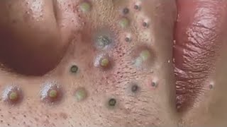 Big Cystic Acne Blackheads Extraction Blackheads amp Milia Whiteheads Removal Pimple Popping  1302 [upl. by Malissia]