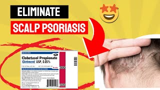 Say Goodbye to Scalp Psoriasis with Clobetasol Propionate A GameChanger [upl. by Moguel]