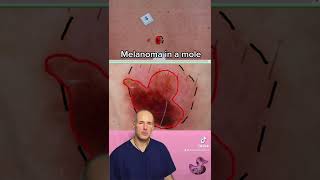 Warning signs of melanoma in moles melanomaawareness melanoma dermatologist moles molecheck [upl. by Neelyaj348]