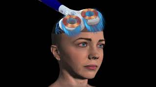 What is rTMS Repetitive Transcranial Magnetic Stimulation [upl. by Broddy]