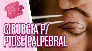 Cirurgia corrige ptose palpebral e excesso de pele nas pálpebras  Você Bonita 260521 [upl. by Loomis]