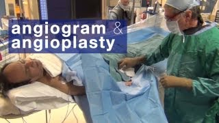 Angiogram amp angioplasty what to expect [upl. by Learsi170]