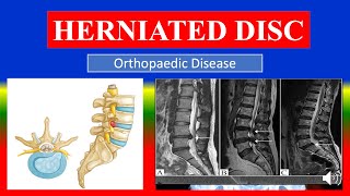 HERNIATED DISC  Definition types causes pathophysiology signs amp symptoms medicine [upl. by Allistir]