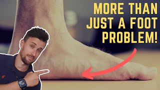 Why Flat Feet Are More Than Just a Foot Problem [upl. by Ayal]