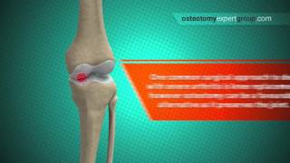 Osteotomy Animation i [upl. by Rufena]