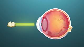 Presbyopia ophthalmology  Animation [upl. by Goff]