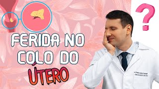 FERIDA NO COLO DO ÚTERO o que é sintomas tratamento prevenção [upl. by Llireva547]