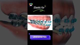 Underbite braces transformation bracesorthodontist dentist shortsfeed [upl. by Stern632]