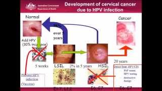 Cervical Cancer Screening Is this the end of the pap smear [upl. by Heilner]