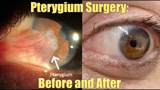 Ptergyium Surgery  Before and After What is it How we remove it Recovery and Results [upl. by Esirtal]