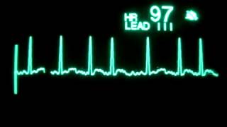 57 Fibrilación Auricular [upl. by Nidnerb304]