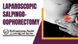 Laparoscopic Salpingooophorectomy for Recurrent Endometrioma A Comprehensive Video Overview [upl. by Portwin]