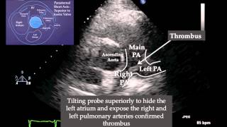 Pulmonary Embolism on Echocardiogram [upl. by Aslehc]