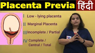 Placenta Previa in Hindi  APH Antepartum HemorrhageTypes Risk factors Symptoms  Nursing Lecture [upl. by Rieger]