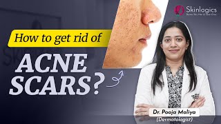 How to get rid of Acne Scars  MNRF treatment for Acne Scars  Best Skin Specialist in Noida [upl. by Arlyn]