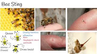 Bee sting  How to treat a bee sting [upl. by Laden]