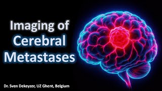 Imaging of cerebral metastases [upl. by Kareem]