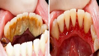 5 Natürliche Wege Zahnstein Schnell Und Effektiv Zu Entfernen [upl. by Abas]