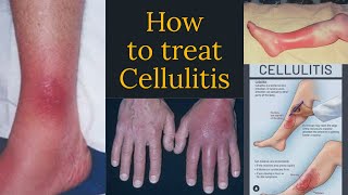 iv antibiotics for cellulitis [upl. by Saretta]