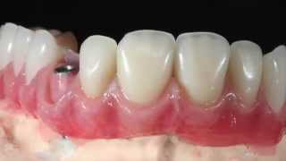 ceramage gingiva [upl. by Emlyn]