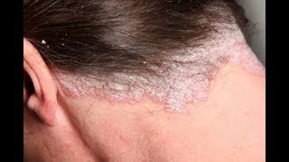 How to Treat Scalp Scabs [upl. by Laresa]