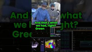 VT mapping with HD Grid catheter [upl. by Anigue]