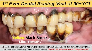 1st Dental Scaling of 50 YO Yellow Black Stains amp Tartar Removal  पायरिया का इलाजI Dr Ram MDS [upl. by Nalyd]