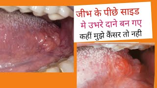 जीभ के पीछे दाने कैसे ठीक करें Bump on side of tongue swollen bumps on side of tongueHow to cure [upl. by Aiyotal]