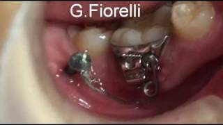 Orthodontic Miniscrew in the mandible [upl. by Yona]