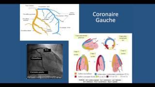 Coronarographie et Angioplastie coronaire [upl. by Koralle187]