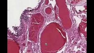 Histopathology Anus Hemorrhoids [upl. by Elnukeda417]