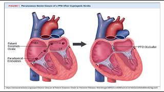 Paradoxical embolism pathology mbbs [upl. by Uahc]