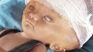 Rare Condition Makes Babys Head 3 Times Larger [upl. by Philander]