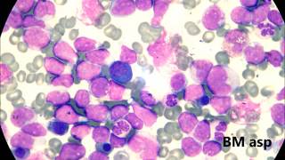 Acute Myeloblastic Leukemia M1 [upl. by Ilime]