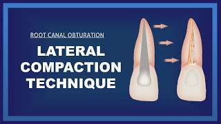 Lateral compaction technique  Root canal Obturation [upl. by Tedie]