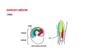 Quadriceps Muscle  quadriceps mujscle injury strain quadriceps contusion [upl. by Hadnama]