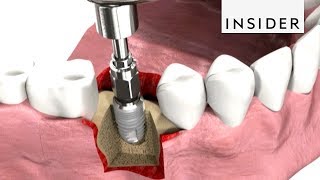 How Dentists Insert Dental Implants [upl. by Ramed]