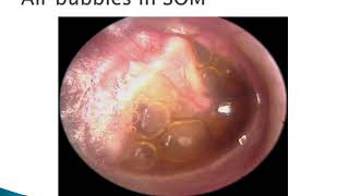 Otitis Media with Effusion  ENT Lecture Series [upl. by Hochman]